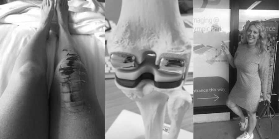 The diary of a knee replacement | Surgery, recovery and rehab